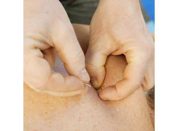 Dry Needling Basic Stockholm, 20.-21. september